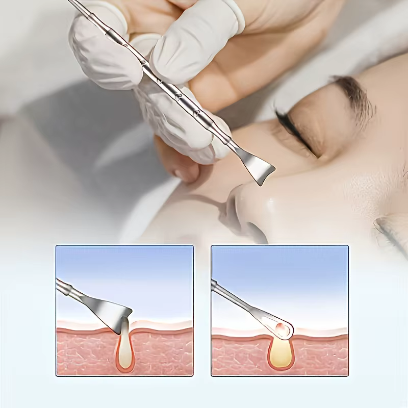 Kit d'extraction de comédons 2 pièces + extracteur de points noirs à double tête