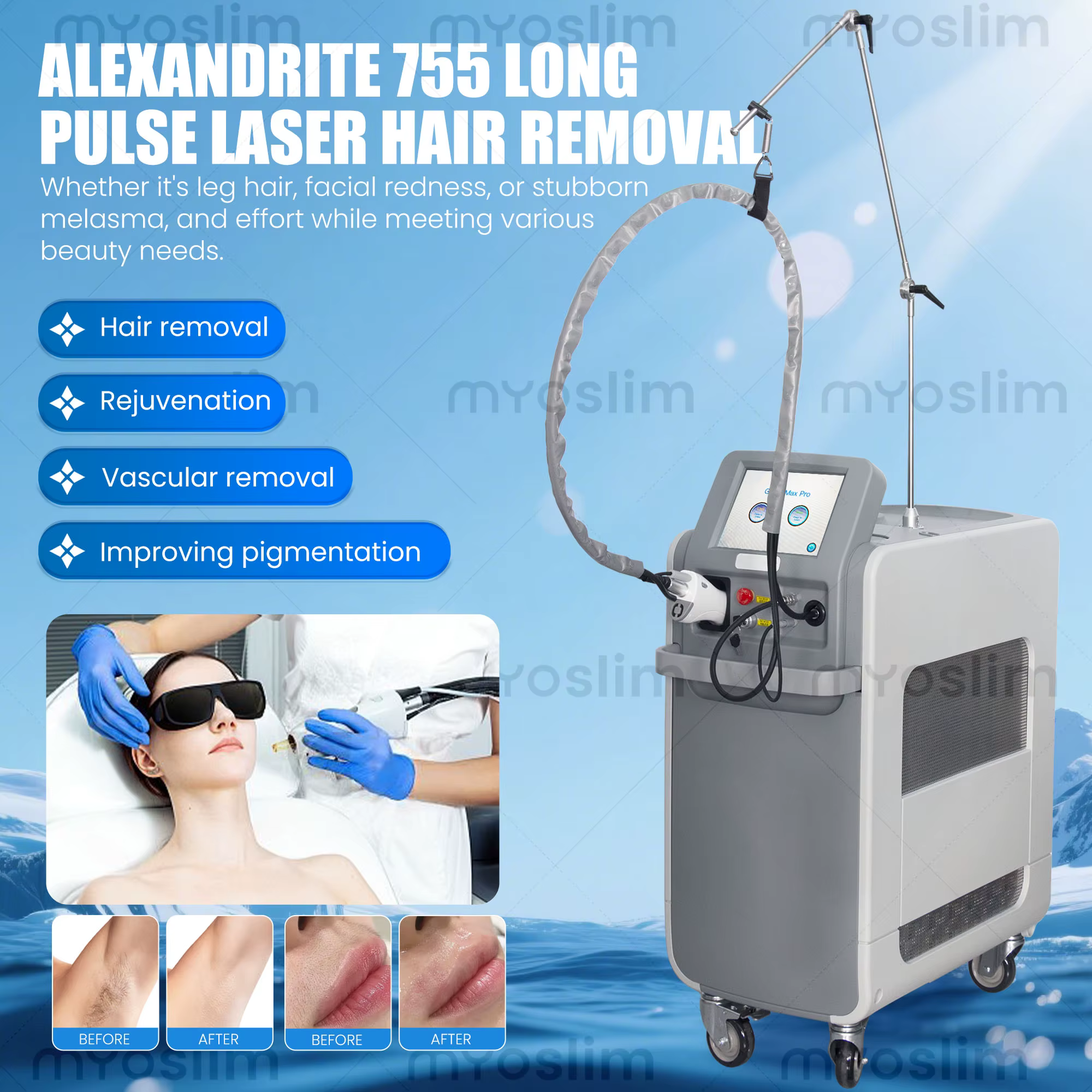 Épilation indolore S Lyric Clinic 755/1064nm Alexandrite Machine | Système de rajeunissement cutané et facial à