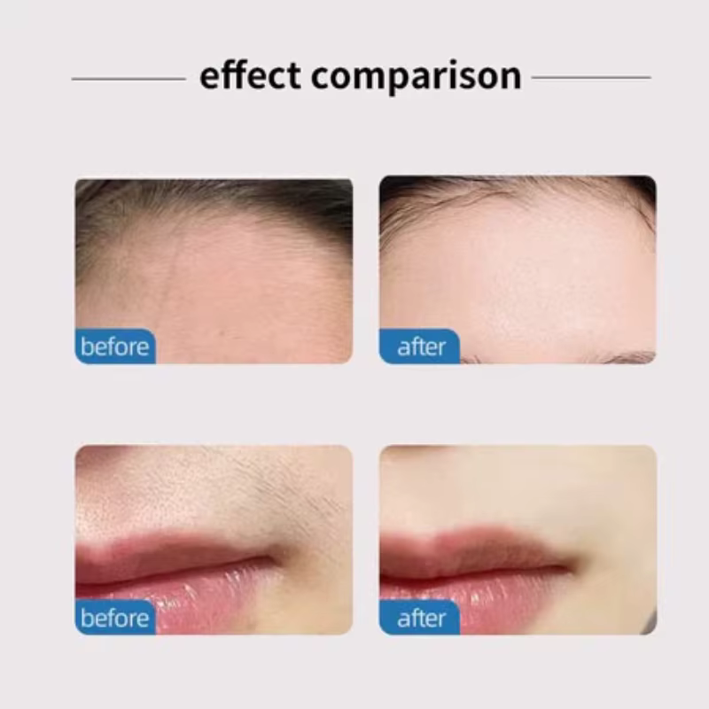 Épilateur Facial, épilation des lèvres