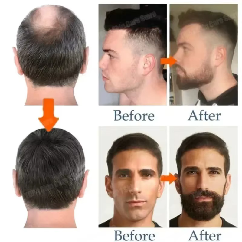 Dites au revoir à l'embarras de la barbe éclatée