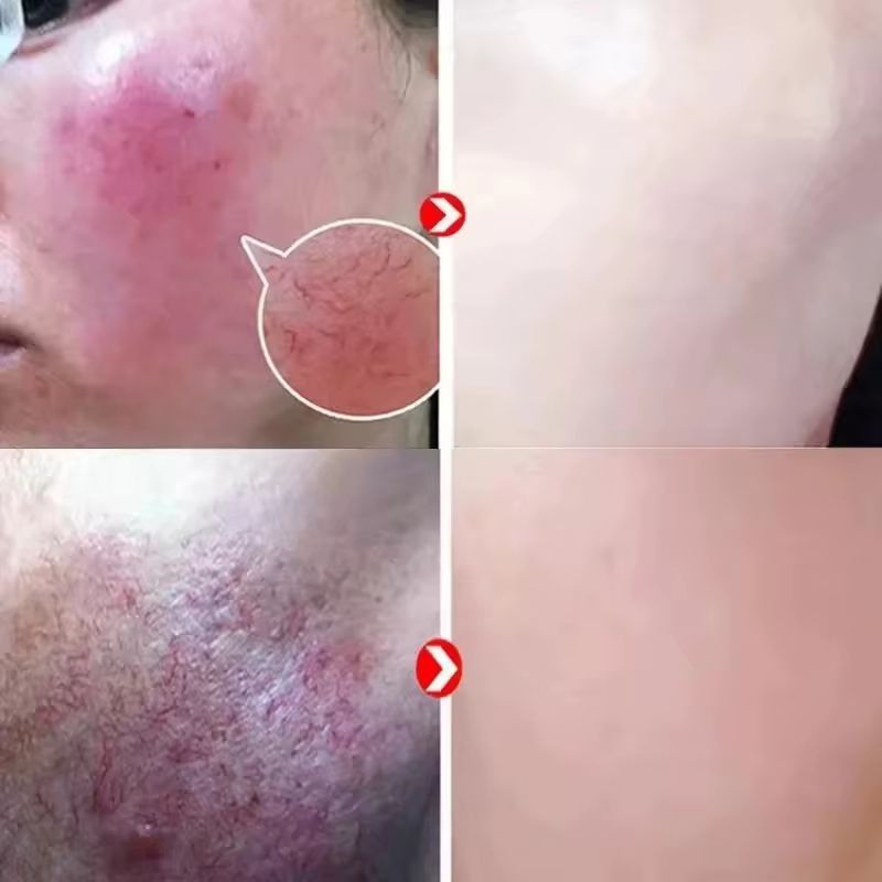 Crème réparatrice pour les rougeurs du visage