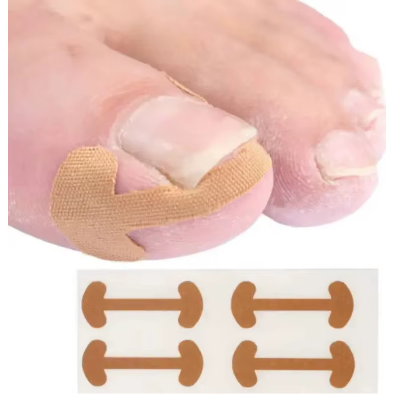 Patch adhésif pour ongles incarnés (5/10/20/30 feuilles) – Autocollant correcteur d'ongles