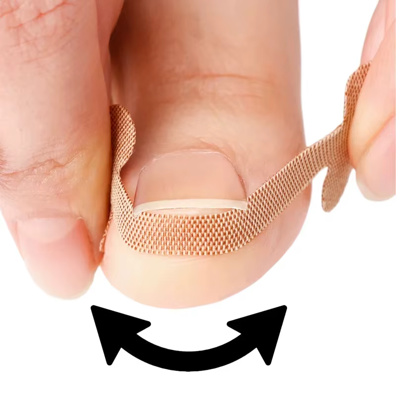 Patch adhésif pour ongles incarnés (5/10/20/30 feuilles) – Autocollant correcteur d'ongles