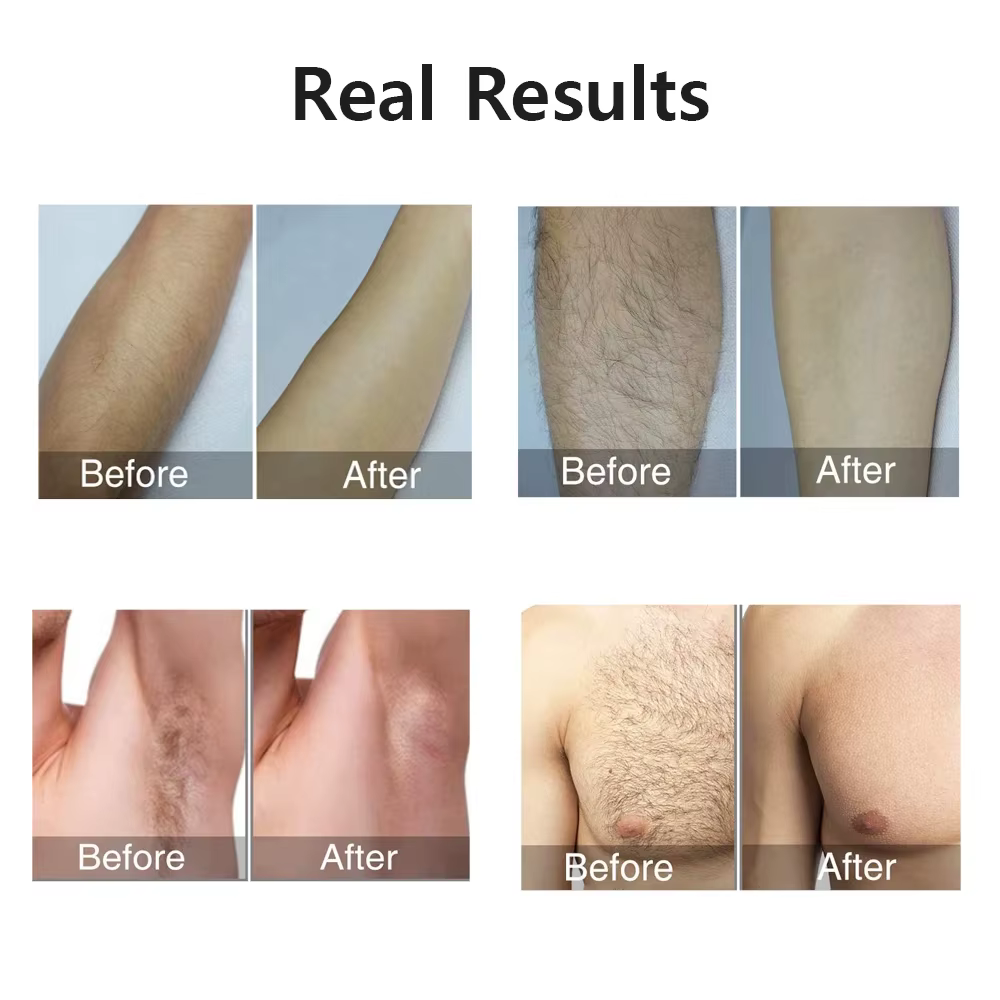 HOMEFISH Laser épilateur IPL épilation pour femmes corps Bikini visage 990000 flashs Permanent indolore IPL