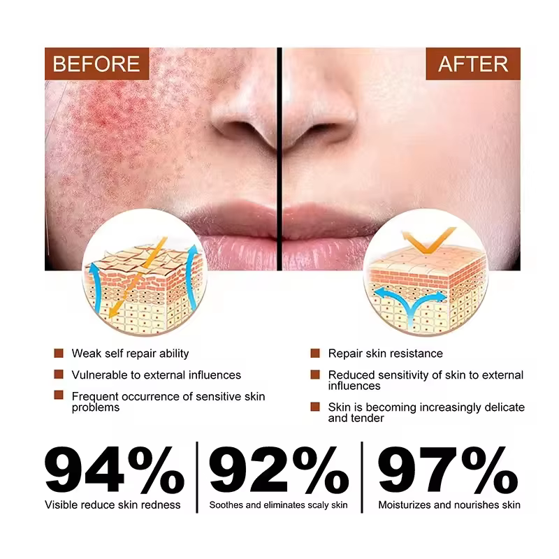 Crème réparatrice pour les rougeurs du visage