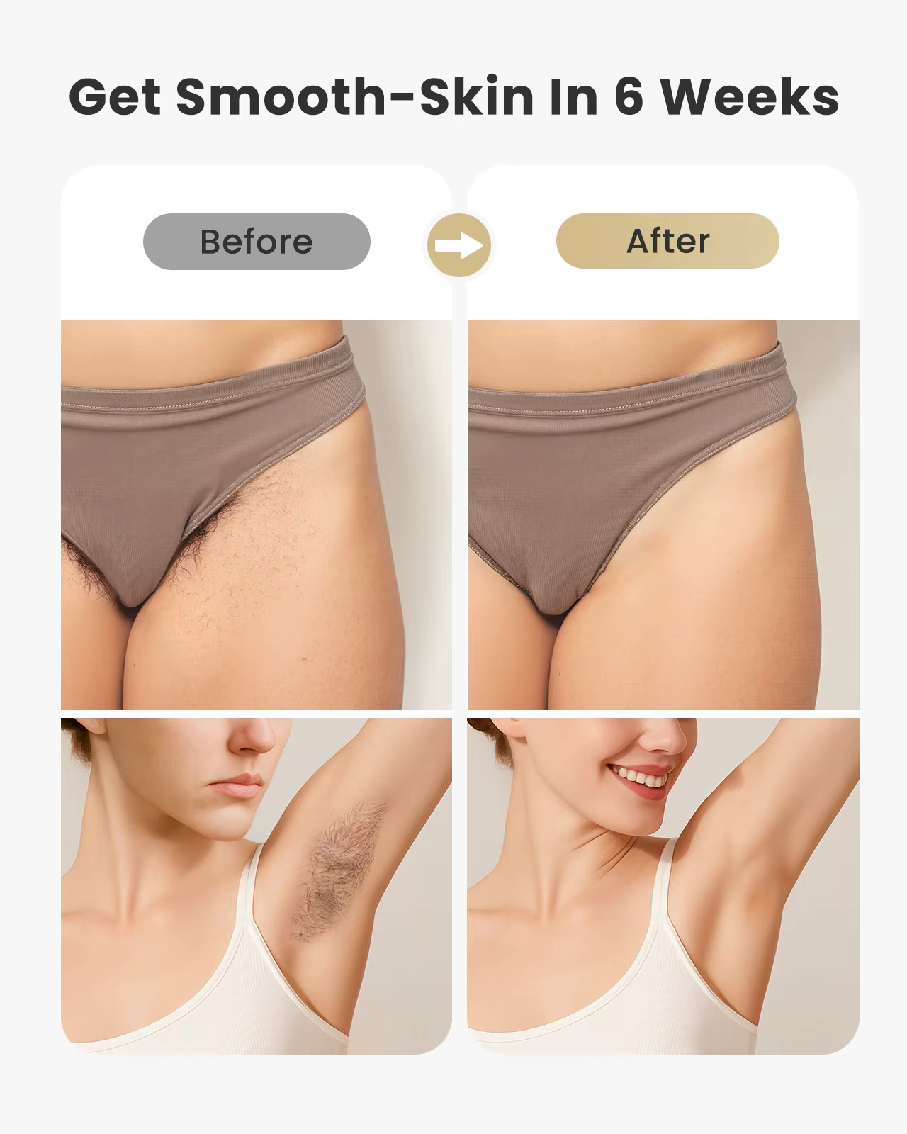 Épilation au laser IPL 0
